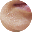 Trockene Haut